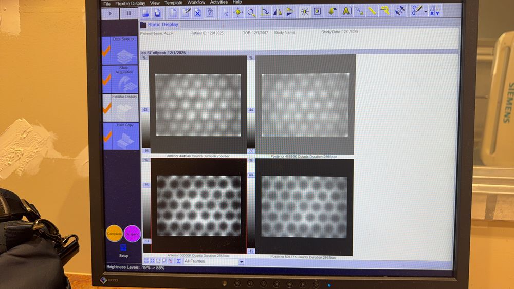Siemens Symbia Evo Nuclear Camera Displaying Anterior and Posterior Images