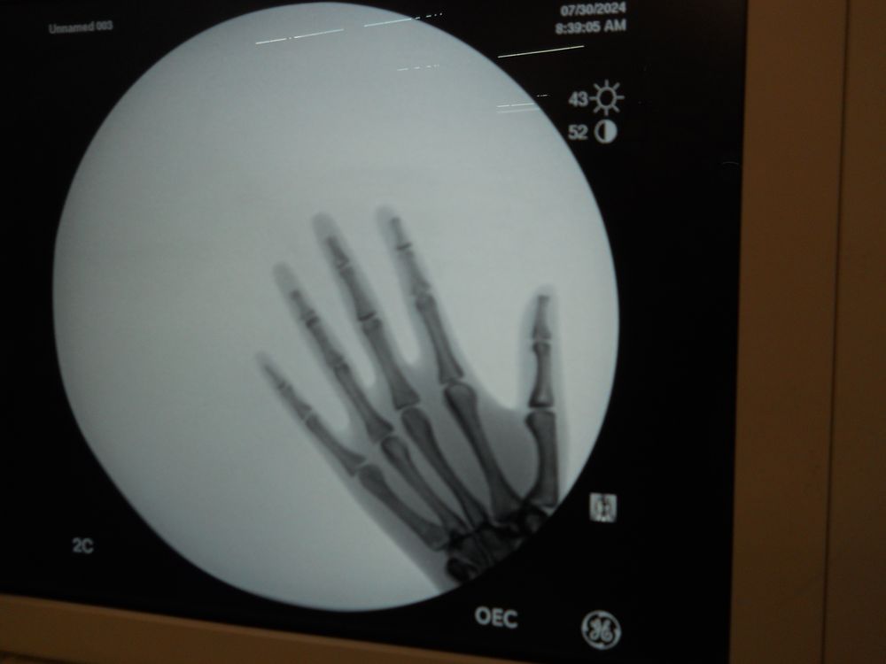 Hand X-Ray on OEC 9900 C-Arm