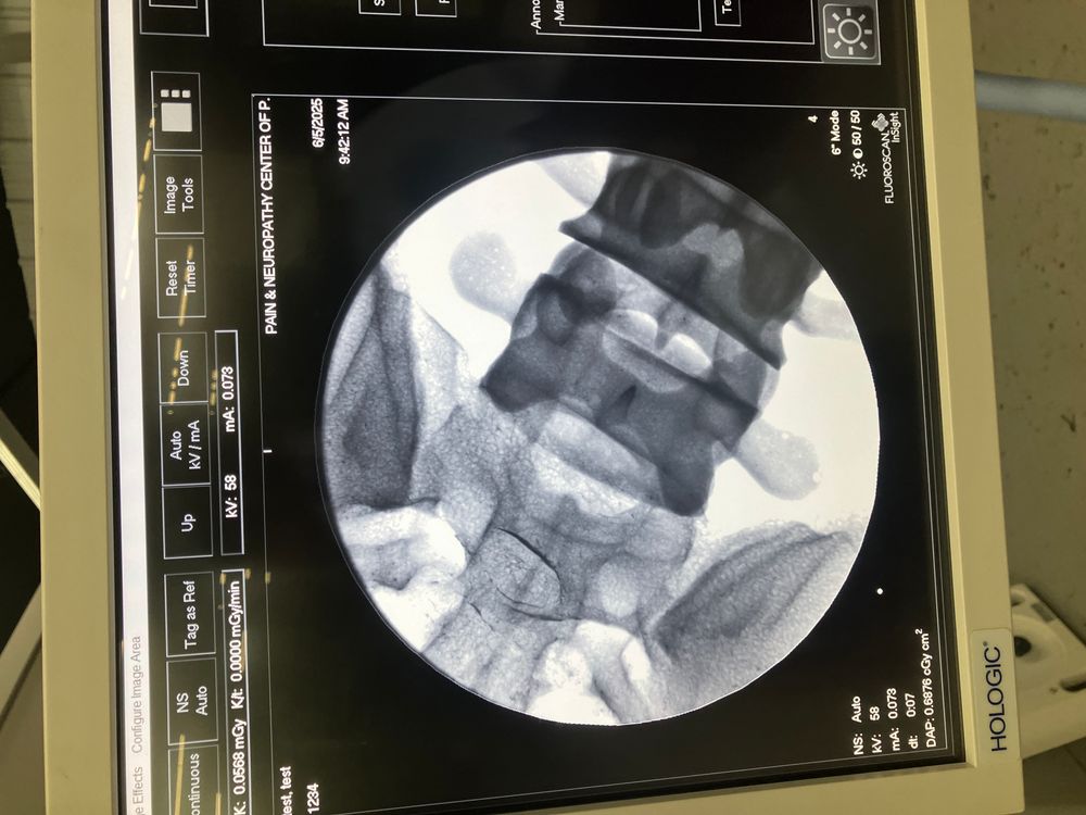Fluoroscan Insight X-ray of Hand on Monitor