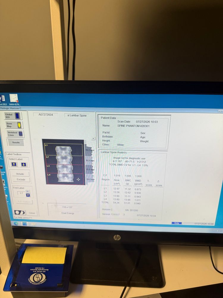 Hologic Horizon C DEXA Lumbar Spine Analysis